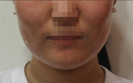 가시매선 Before