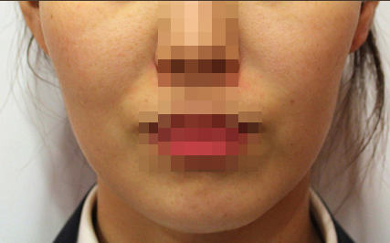 팔자매선 Before