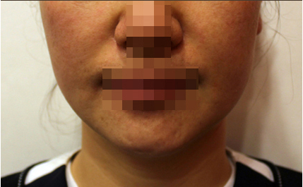 팔자매선 Before