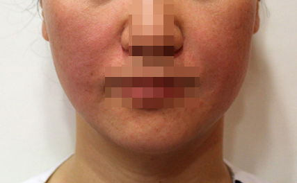 팔자매선 After
